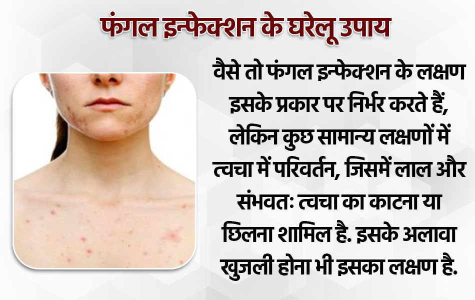 फंगल इन्फेक्शन से परेशान मरीज अपनाएं ये आसान टिप्स, बारिश के मौसम में त्वचा का रखें ख्याल